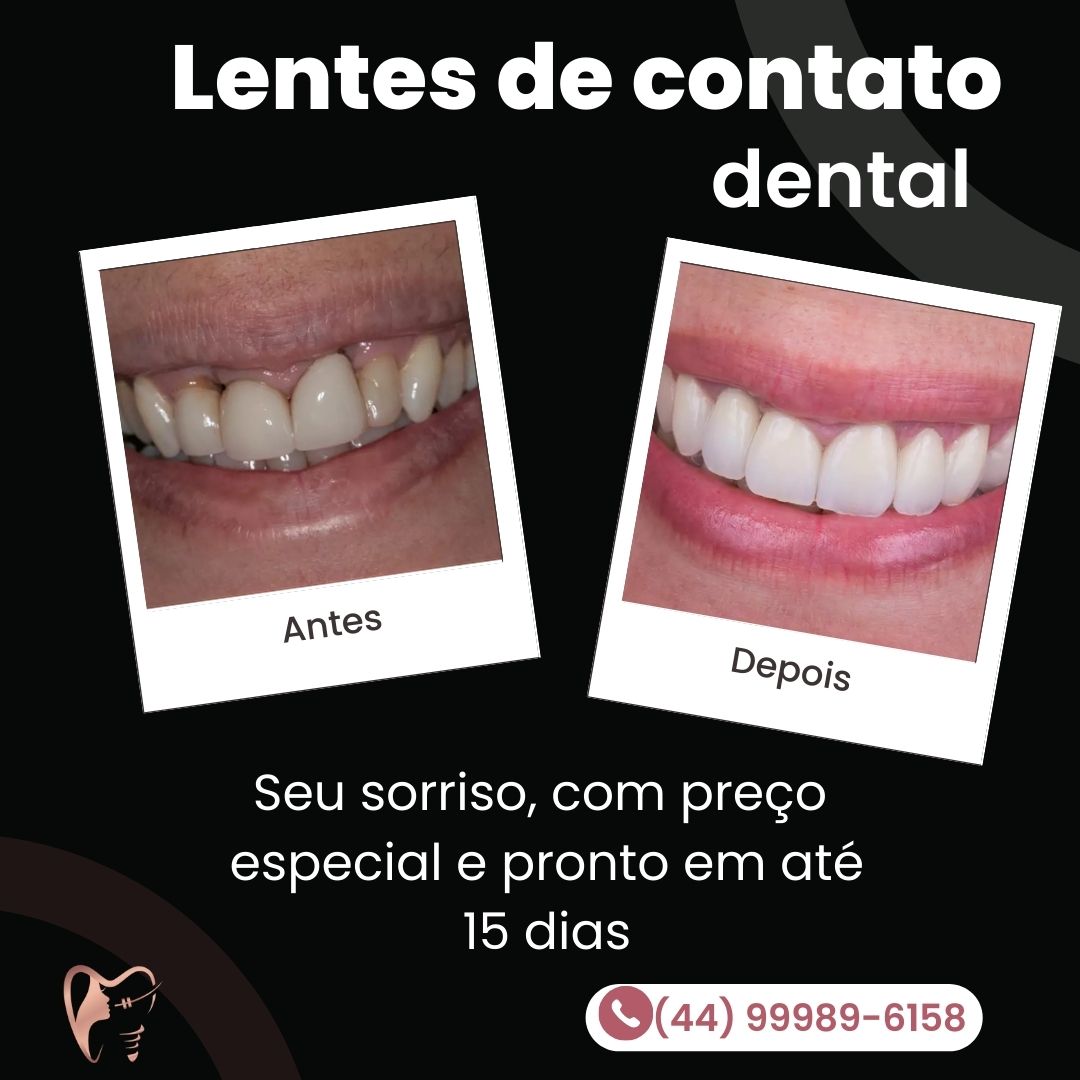 post de Instagram antes e depois clareamento dental azul e branco moderno